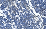 IHC staining of FFPE human lung cancer with Glucosidase Alpha Acid antibody. HIER: boil tissue sections in pH8 EDTA for 20 min and allow to cool before testing.
