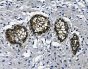 IHC staining of FFPE human breast cancer with Glucosidase Alpha Acid antibody. HIER: boil tissue sections in pH8 EDTA for 20 min and allow to cool before testing.