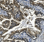 IHC staining of FFPE human prostate cancer with Glucosidase Alpha Acid antibody. HIER: boil tissue sections in pH8 EDTA for 20 min and allow to cool before testing.