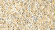 IHC staining of FFPE human glioma with GFAP antibody. HIER: boil tissue sections in pH8 EDTA for 20 min and allow to cool before testing.