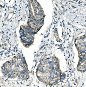 IHC staining of FFPE human breast cancer with ANGPT2 antibody. HIER: boil tissue sections in pH8 EDTA for 20 min and allow to cool before testing.