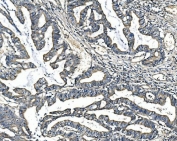 IHC staining of FFPE human rectal cancer with ANGPT2 antibody. HIER: boil tissue sections in pH8 EDTA for 20 min and allow to cool before testing.