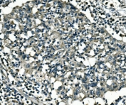 IHC staining of FFPE human lung cancer with PCTAIRE1 antibody. HIER: boil tissue sections in pH8 EDTA for 20 min and allow to cool before testing.