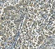 IHC staining of FFPE human lung cancer with EIF4A1 antibody. HIER: boil tissue sections in pH8 EDTA for 20 min and allow to cool before testing.
