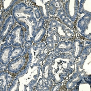 IHC staining of FFPE human rectal cancer with F2R antibody. HIER: boil tissue sections in pH8 EDTA for 20 min and allow to cool before testing.