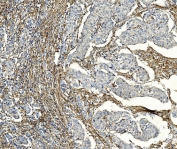 IHC staining of FFPE human breast cancer with F2R antibody. HIER: boil tissue sections in pH8 EDTA for 20 min and allow to cool before testing.