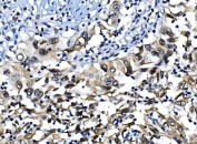 IHC staining of FFPE human lung cancer with IRF-1 antibody. HIER: boil tissue sections in pH8 EDTA for 20 min and allow to cool before testing.