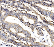 IHC staining of FFPE human rectal cancer with MC4-R antibody. HIER: boil tissue sections in pH8 EDTA for 20 min and allow to cool before testing.