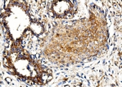 IHC staining of FFPE human breast cancer with MORC3 antibody. HIER: boil tissue sections in pH8 EDTA for 20 min and allow to cool before testing.