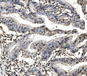 IHC staining of FFPE human rectal cancer with MORC3 antibody. HIER: boil tissue sections in pH8 EDTA for 20 min and allow to cool before testing.