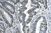 IHC staining of FFPE human rectal cancer with SLBP antibody. HIER: boil tissue sections in pH8 EDTA for 20 min and allow to cool before testing.