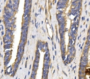 IHC staining of FFPE human prostate cancer tissue with SLC2A9 antibody. HIER: boil tissue sections in pH8 EDTA for 20 min and allow to cool before testing.