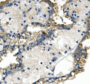 IHC staining of FFPE human renal cancer tissue with SLC2A9 antibody. HIER: boil tissue sections in pH8 EDTA for 20 min and allow to cool before testing.