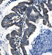 IHC staining of FFPE human rectal cancer with VMAT1 antibody. HIER: boil tissue sections in pH8 EDTA for 20 min and allow to cool before testing.