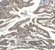 IHC staining of FFPE human rectal cancer with TTK antibody. HIER: boil tissue sections in pH8 EDTA for 20 min and allow to cool before testing.