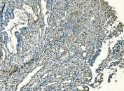 IHC staining of FFPE human colorectal cancer with CD59 antibody. HIER: boil tissue sections in pH8 EDTA for 20 min and allow to cool before testing.