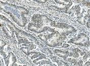 IHC staining of FFPE human rectal cancer with ATF1 antibody. HIER: boil tissue sections in pH8 EDTA for 20 min and allow to cool before testing.