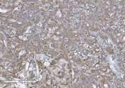 IHC staining of FFPE human liver cancer with NOD1 antibody. HIER: boil tissue sections in pH8 EDTA for 20 min and allow to cool before testing.
