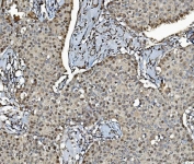 IHC staining of FFPE human breast cancer with MCM4 antibody. HIER: boil tissue sections in pH8 EDTA for 20 min and allow to cool before testing.