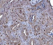 IHC staining of FFPE human gallbladder adenocarcinoma with MCM4 antibody. HIER: boil tissue sections in pH8 EDTA for 20 min and allow to cool before testing.