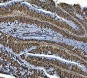 IHC staining of FFPE human rectal cancer with MCM4 antibody. HIER: boil tissue sections in pH8 EDTA for 20 min and allow to cool before testing.