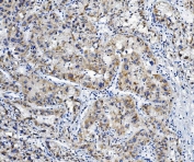 IHC staining of FFPE human liver cancer with ALDH6A1 antibody. HIER: boil tissue sections in pH8 EDTA for 20 min and allow to cool before testing.