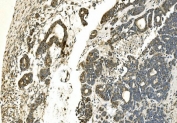 IHC staining of FFPE human ovarian cancer with CA13 antibody. HIER: boil tissue sections in pH8 EDTA for 20 min and allow to cool before testing.