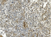 IHC staining of FFPE human liver cancer with CA13 antibody. HIER: boil tissue sections in pH8 EDTA for 20 min and allow to cool before testing.