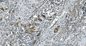 IHC staining of FFPE human bladder cancer with CDC123 antibody. HIER: boil tissue sections in pH8 EDTA for 20 min and allow to cool before testing.