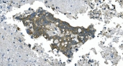 IHC staining of FFPE human pancreatic cancer with CDC123 antibody. HIER: boil tissue sections in pH8 EDTA for 20 min and allow to cool before testing.