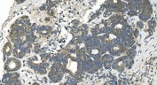 IHC staining of FFPE human ovarian cancer with CDC123 antibody. HIER: boil tissue sections in pH8 EDTA for 20 min and allow to cool before testing.