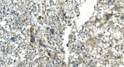 IHC staining of FFPE human liver cancer with CDC123 antibody. HIER: boil tissue sections in pH8 EDTA for 20 min and allow to cool before testing.