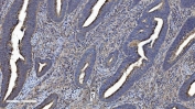 IHC staining of FFPE human colorectal cancer with CMBL antibody. HIER: boil tissue sections in pH8 EDTA for 20 min and allow to cool before testing.