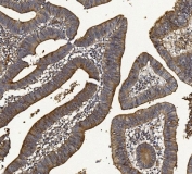 IHC staining of FFPE human rectal cancer with Mucin 1 antibody. HIER: boil tissue sections in pH8 EDTA for 20 min and allow to cool before testing.