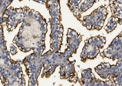 IHC staining of FFPE human renal cancer with Mucin 1 antibody. HIER: boil tissue sections in pH8 EDTA for 20 min and allow to cool before testing.