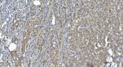 IHC staining of FFPE human renal carcinoma with GLRX2 antibody. HIER: boil tissue sections in pH8 EDTA for 20 min and allow to cool before testing.