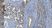 IHC staining of FFPE human bladder cancer with GLRX2 antibody. HIER: boil tissue sections in pH8 EDTA for 20 min and allow to cool before testing.