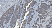 IHC staining of FFPE human ovarian cancer with GLRX2 antibody. HIER: boil tissue sections in pH8 EDTA for 20 min and allow to cool before testing.