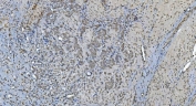IHC staining of FFPE human gastric cancer with GLRX2 antibody. HIER: boil tissue sections in pH8 EDTA for 20 min and allow to cool before testing.