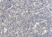 IHC staining of FFPE human melanoma with HYI antibody. HIER: boil tissue sections in pH8 EDTA for 20 min and allow to cool before testing.