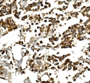 IHC staining of FFPE human pancreatic cancer with IGF-1 antibody. HIER: boil tissue sections in pH8 EDTA for 20 min and allow to cool before testing.