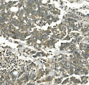 IHC staining of FFPE human pancreatic cancer with Galectin-2 antibody. HIER: boil tissue sections in pH8 EDTA for 20 min and allow to cool before testing.