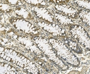 IHC staining of FFPE human rectal cancer with Galectin-2 antibody. HIER: boil tissue sections in pH8 EDTA for 20 min and allow to cool before testing.