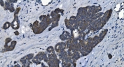 IHC staining of FFPE human ovarian cancer with MAP4K5 antibody. HIER: boil tissue sections in pH8 EDTA for 20 min and allow to cool before testing.