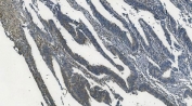 IHC staining of FFPE human rectal cancer with MAPK11 antibody. HIER: boil tissue sections in pH8 EDTA for 20 min and allow to cool before testing.