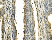 IHC staining of FFPE human rectal cancer with PSME2 antibody. HIER: boil tissue sections in pH8 EDTA for 20 min and allow to cool before testing.
