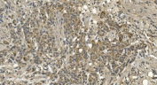 IHC staining of FFPE human renal carcinoma with RGS6 antibody. HIER: boil tissue sections in pH8 EDTA for 20 min and allow to cool before testing.