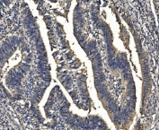 IHC staining of FFPE human rectal cancer with SORD antibody. HIER: boil tissue sections in pH8 EDTA for 20 min and allow to cool before testing.