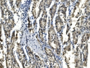 IHC staining of FFPE human liver cancer with SORD antibody. HIER: boil tissue sections in pH8 EDTA for 20 min and allow to cool before testing.
