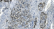 IHC staining of FFPE human gastric cancer with TMBIM1 antibody. HIER: boil tissue sections in pH8 EDTA for 20 min and allow to cool before testing.